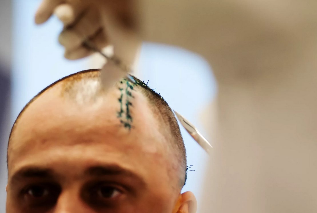 Трепанация черепа