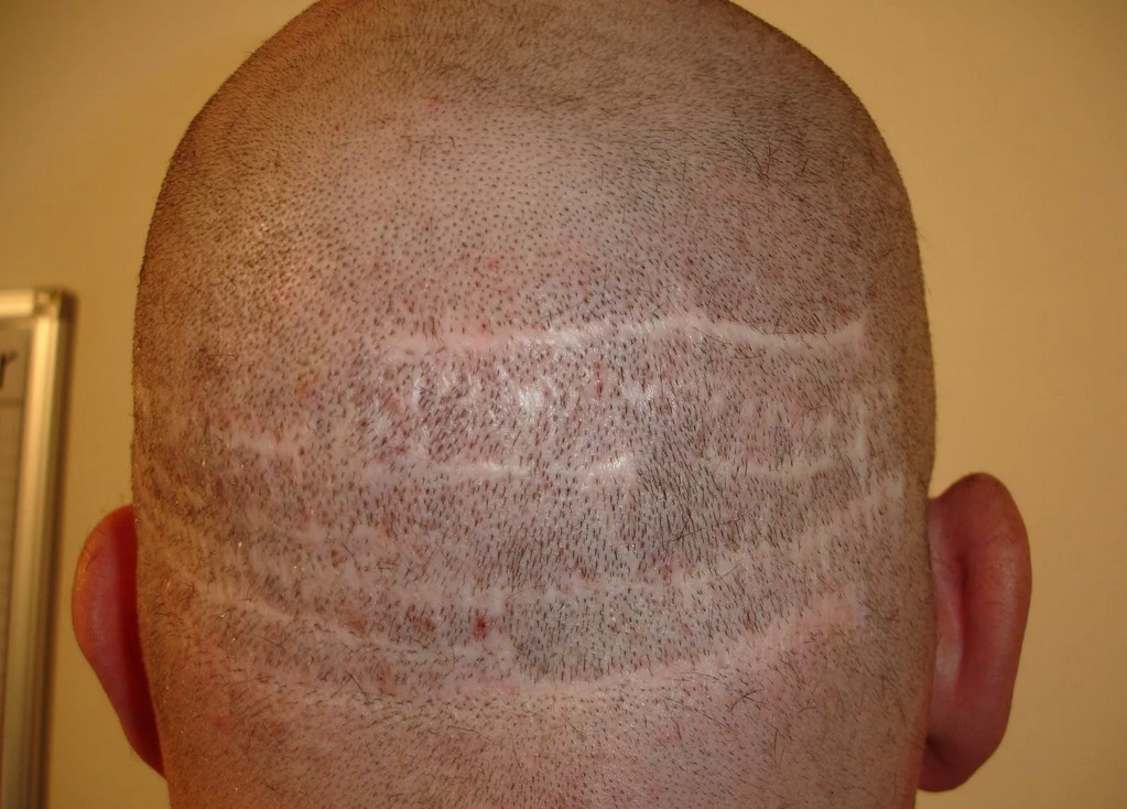 Трепанация черепа