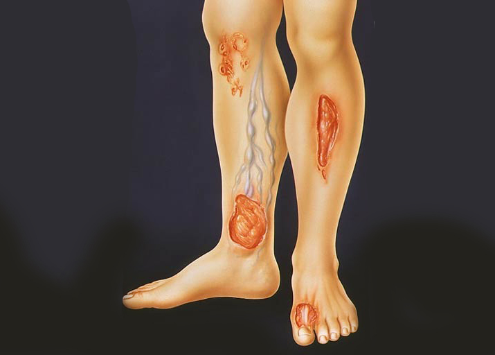 трофическая язва