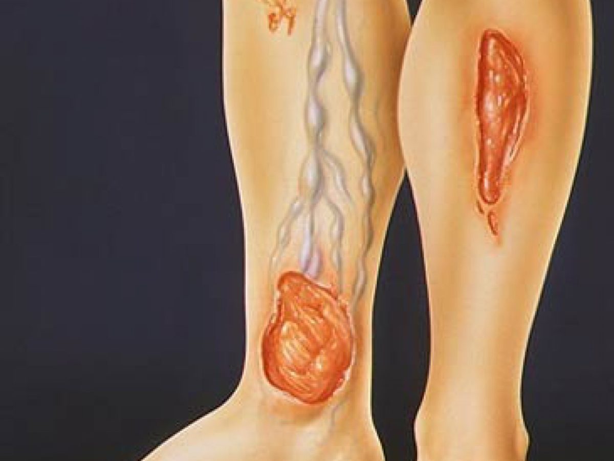 Трофическая язва