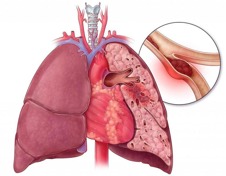 Тромбоэмболия патология