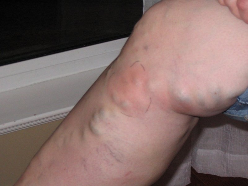 вены на ногах