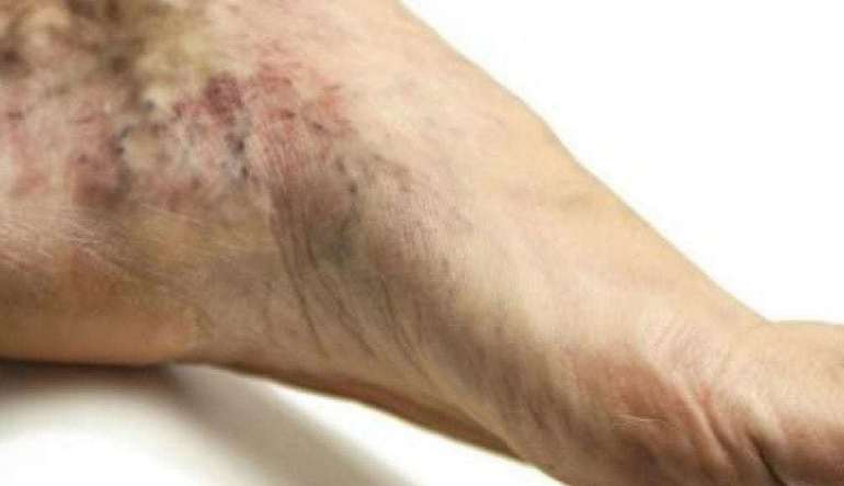 Тромбоз поверхностных вен нижних конечностей