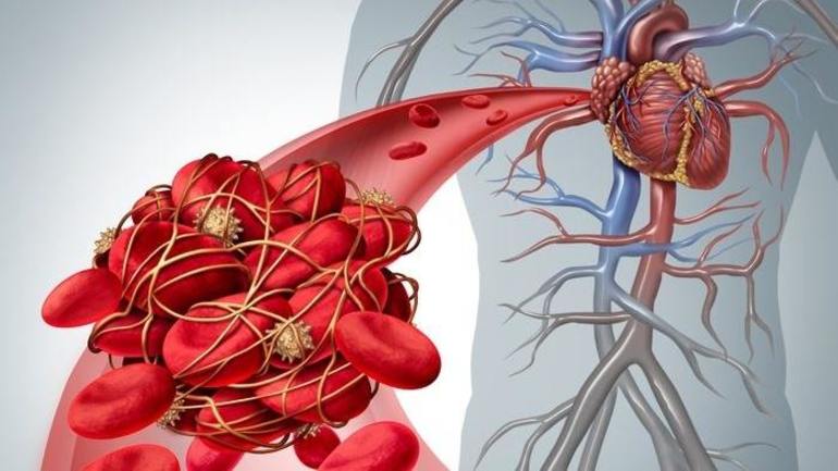 Тромбозы сосудов.