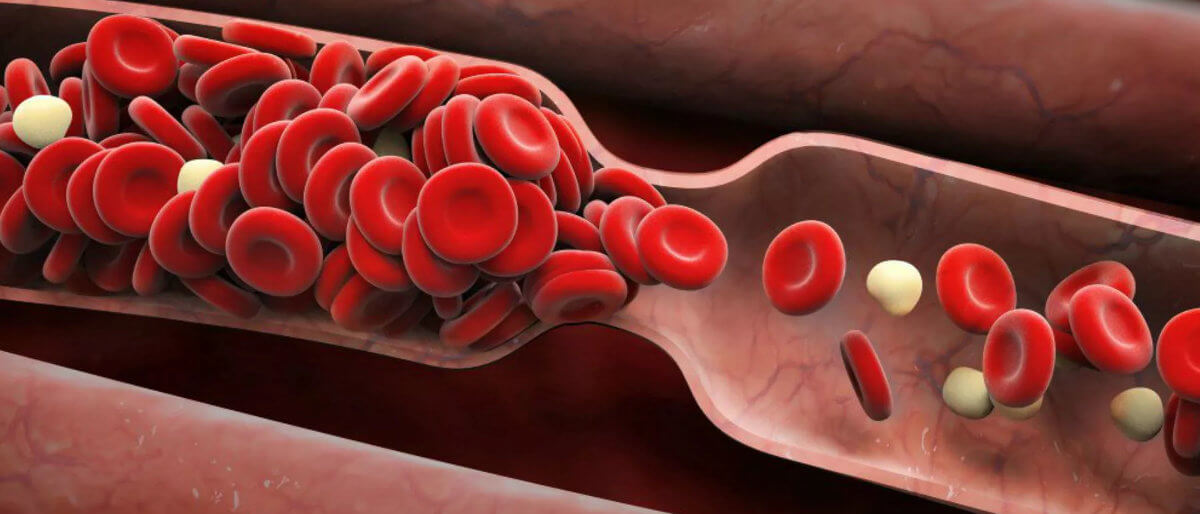 Тромболитическая терапия