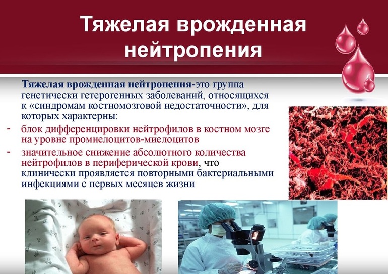 Тяжелая врожденная нейтропиния