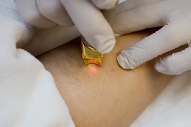 лечение лазером