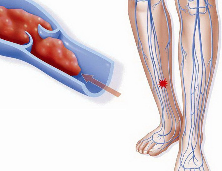 Уменьшение риска образования тромбов