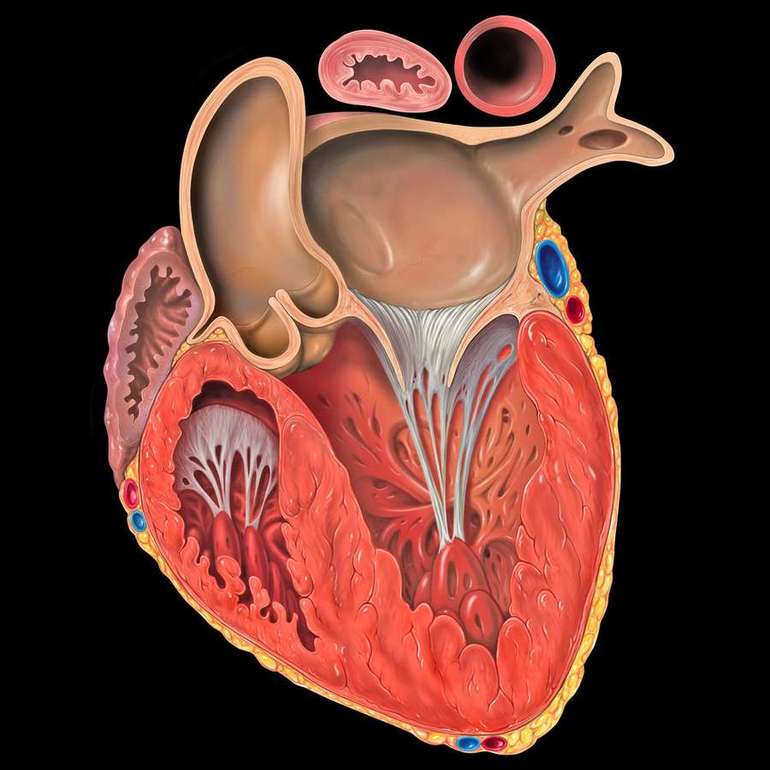 Утолщённые и растянутые стенки миокарда
