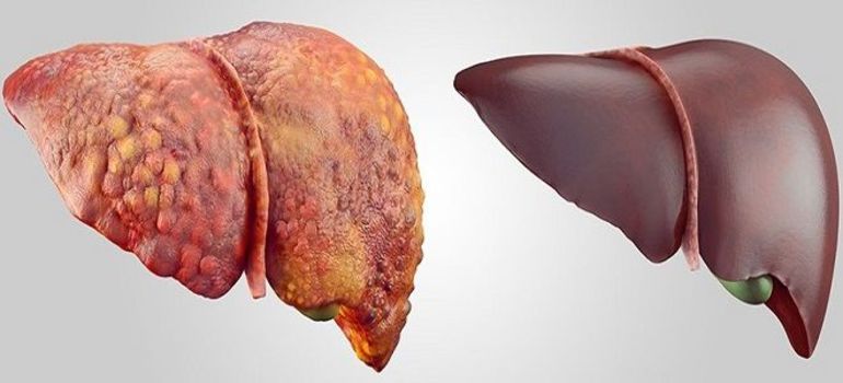 Увеличение печени