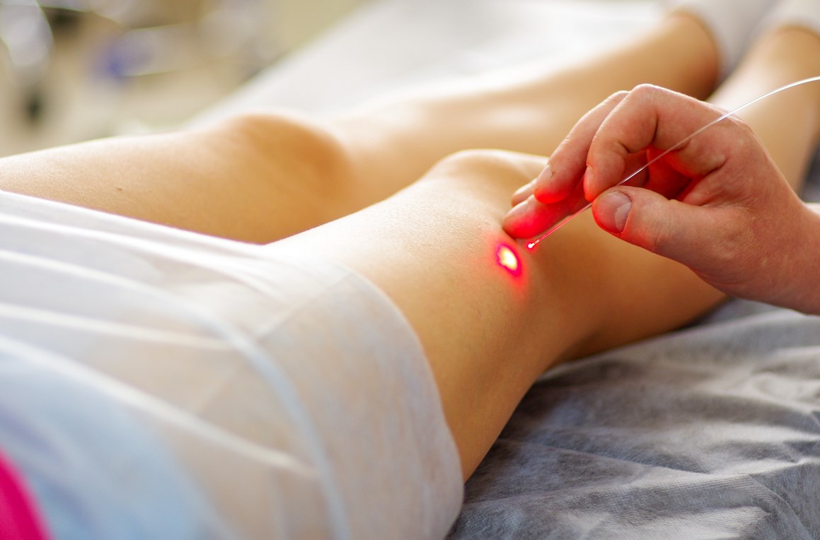 Вены на ногах