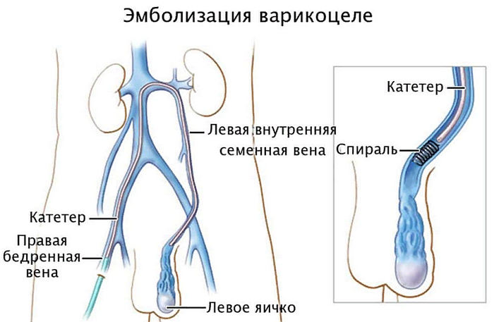 варикоцеле