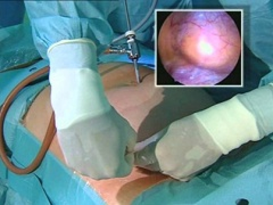 варикоцеле