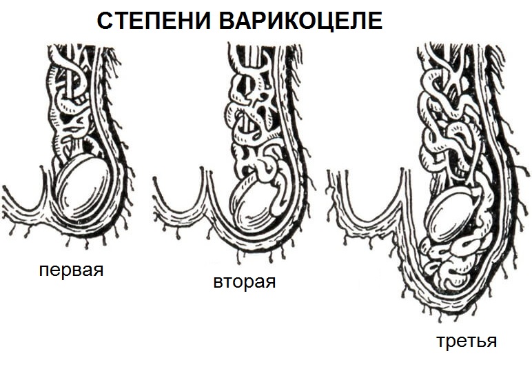 варикоцеле