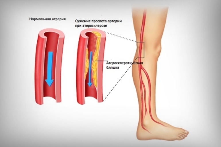 Варикозное расширение вен