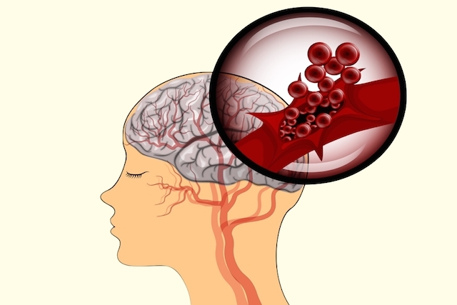 геморрагический инсульт
