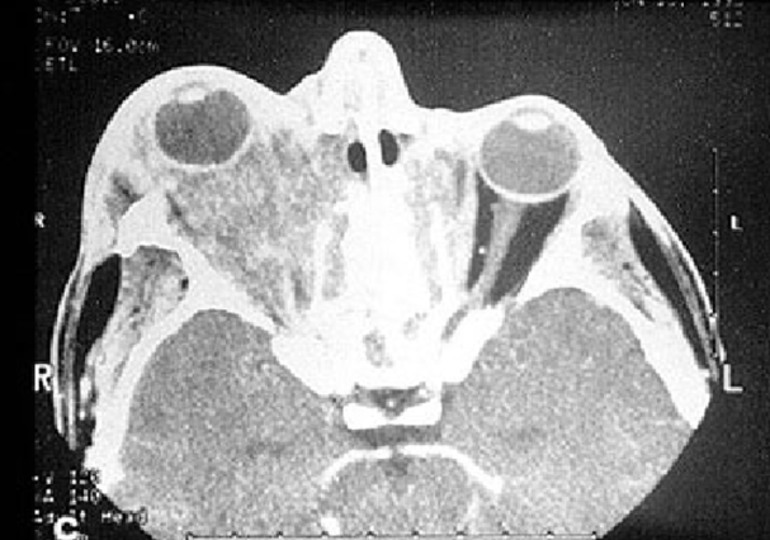 Васкулит вегенера