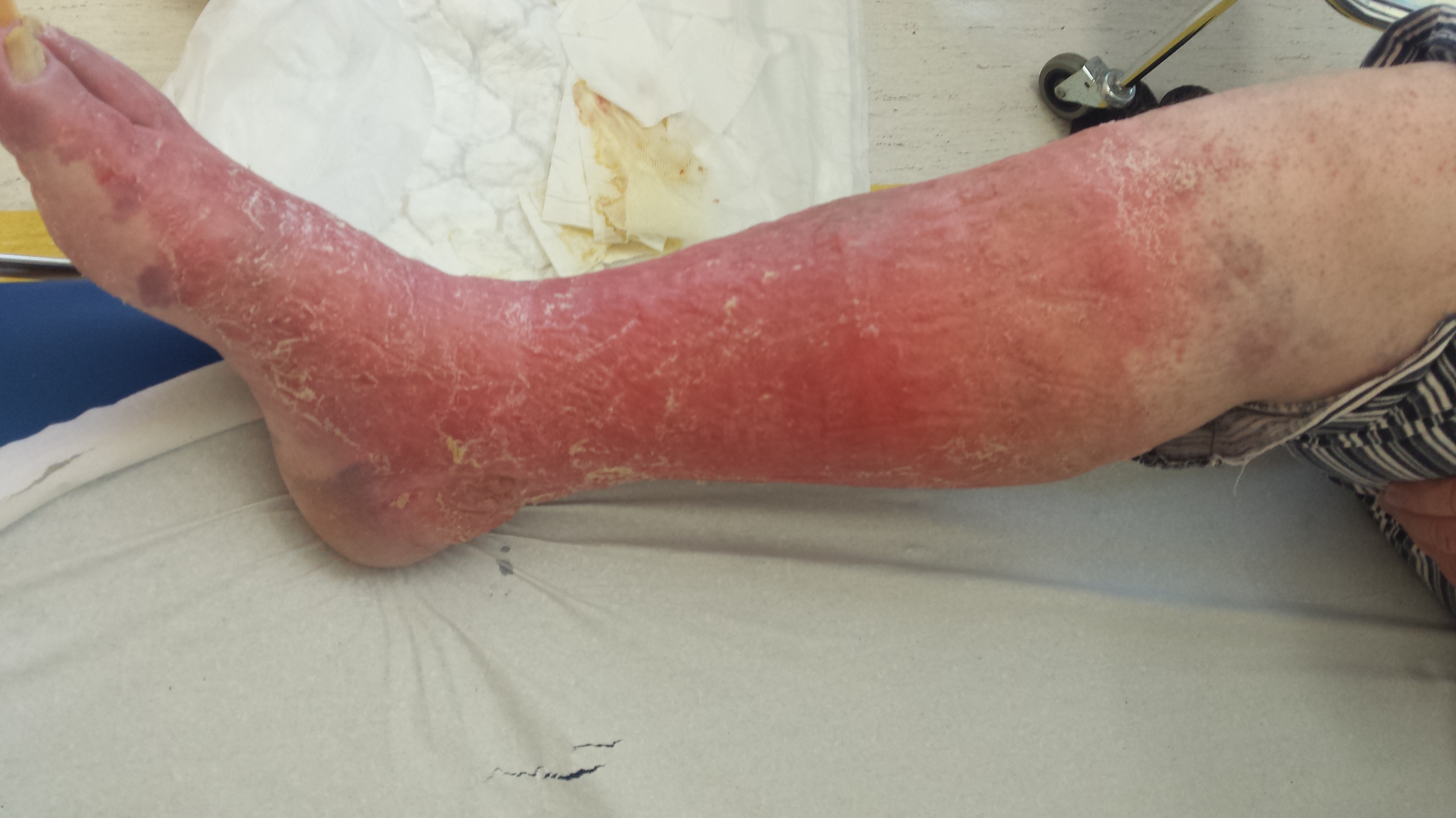 венозная недостаточность