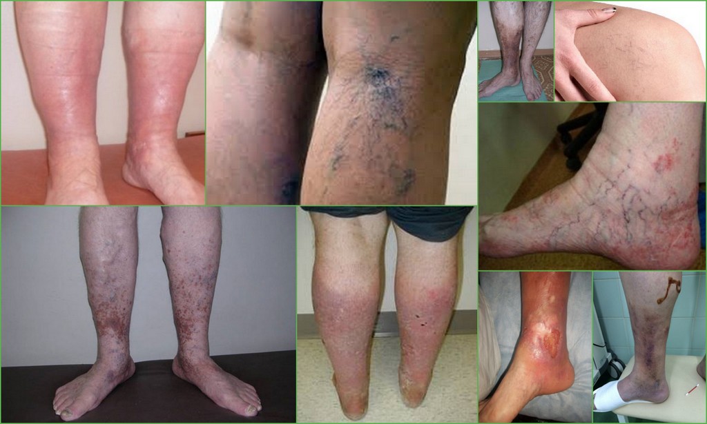 венозная недостаточность