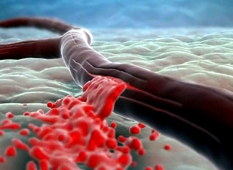 Венозное кровотечение