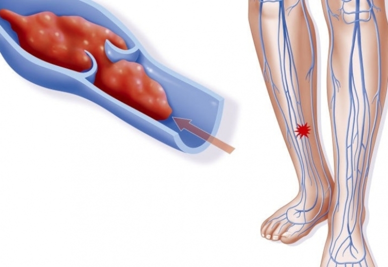 Венозные тромбы