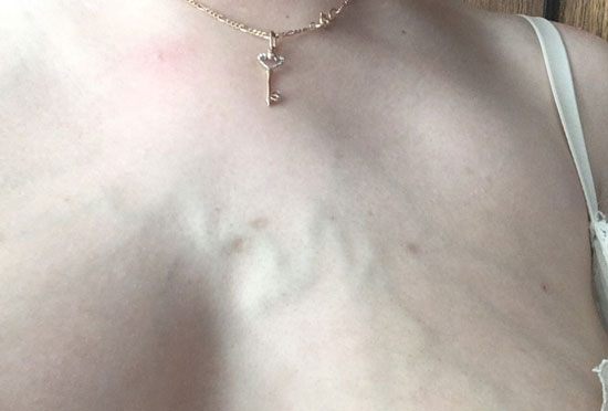 Видны вены на грудной клетке у женщин