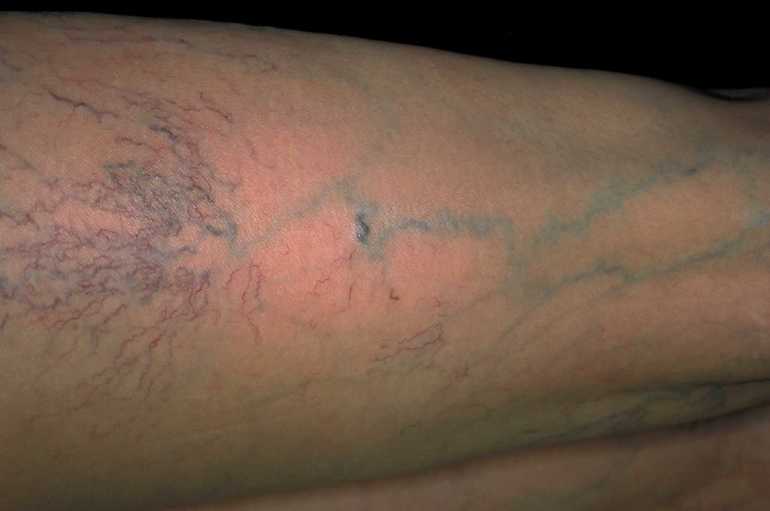 Видимые подкожные вены