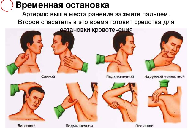 vidy_i_sposoby_ostanovki_krovotecheniy