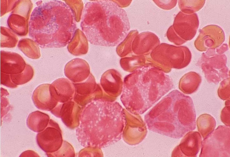 Виды лейкемии