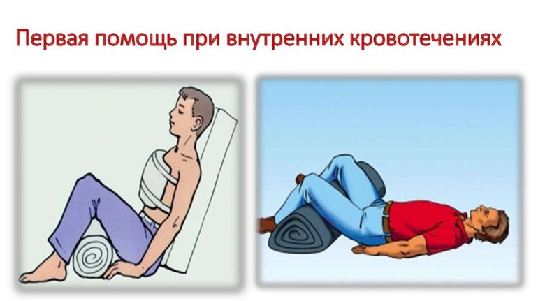 Внутреннее кровотечение признаки и первая помощь