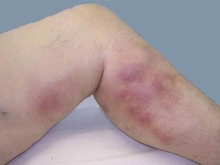 Воспалительные патологии артерий и вен