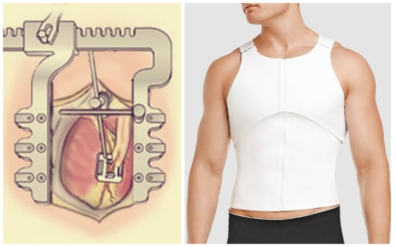 Восстановление после шунтирования сердца