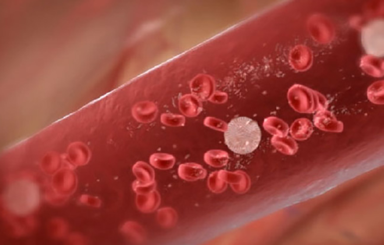 Заболевание лимфоцитоз