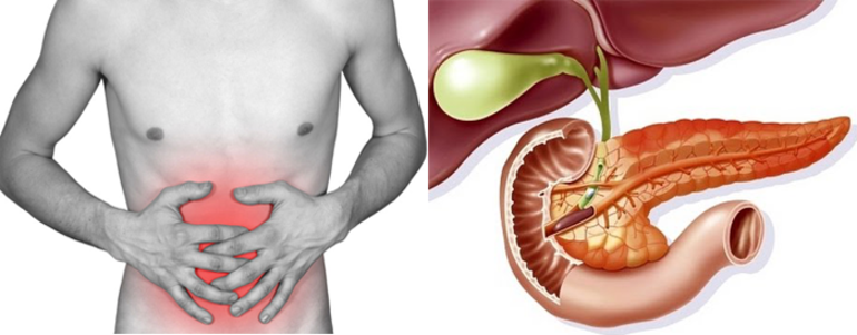 Заболевание панкреонекроз