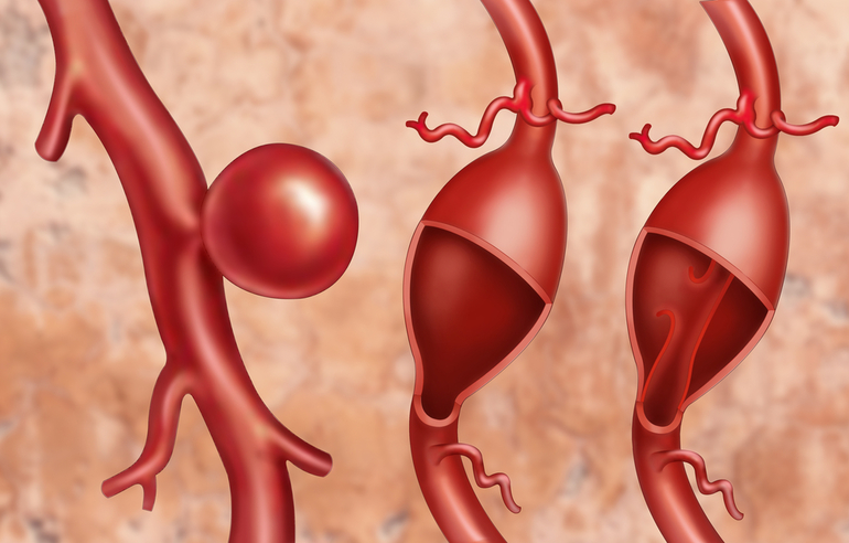 Заболевания сосудов головного мозга