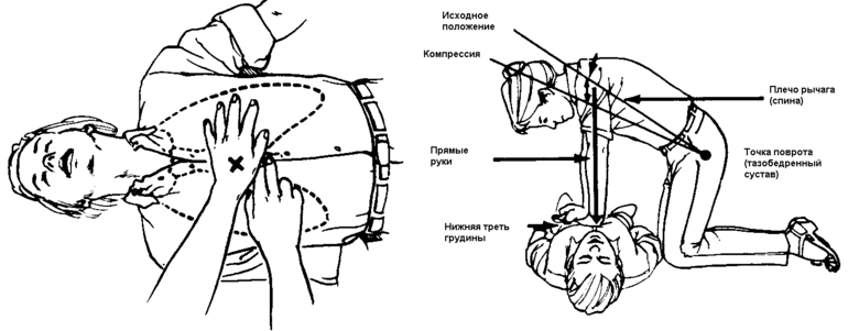 закрытый массаж сердца