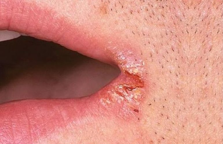 Железодефицитная анемия